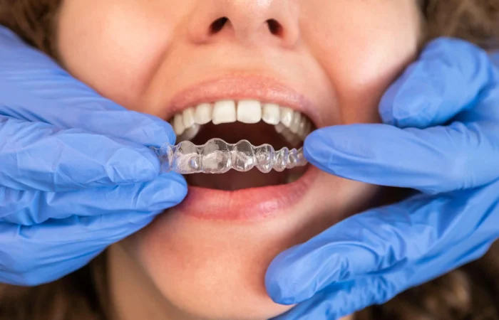 Ortodontik tedavi denildiğinde akla ilk olarak metal diş telleri gelse de, teknolojiyle birlikte estetik ve konforu bir araya getiren şeffaf plak tedavisi (Invisalign) giderek daha fazla tercih edilmektedir. Özellikle yetişkin bireyler için görünmez bir alternatif sunan bu yöntem, hem etkili hem de günlük yaşamı minimum düzeyde etkileyen bir ortodontik çözümdür.