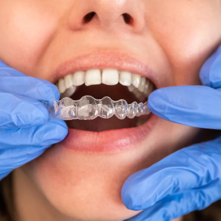 Ortodontik tedavi denildiğinde akla ilk olarak metal diş telleri gelse de, teknolojiyle birlikte estetik ve konforu bir araya getiren şeffaf plak tedavisi (Invisalign) giderek daha fazla tercih edilmektedir. Özellikle yetişkin bireyler için görünmez bir alternatif sunan bu yöntem, hem etkili hem de günlük yaşamı minimum düzeyde etkileyen bir ortodontik çözümdür.