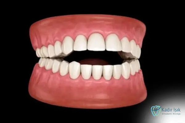 Açık Kapanış (Open Bite)