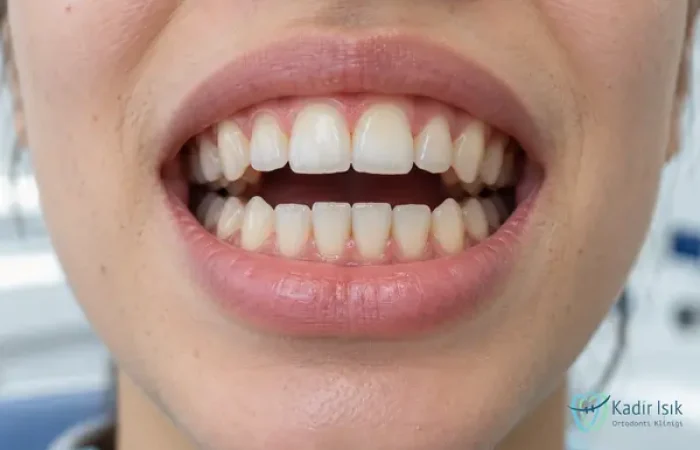 Açık Kapanış (Open Bite)