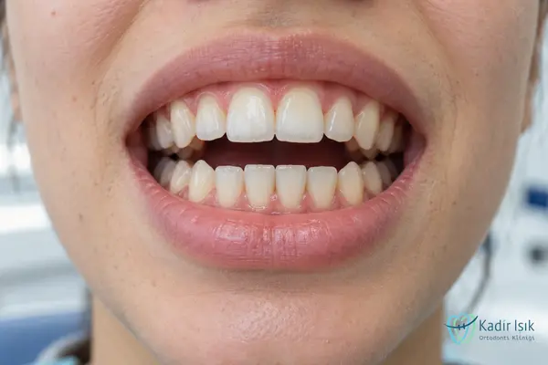 Açık Kapanış (Open Bite)